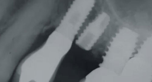 RESISTA - Ext Implant Remover - Video